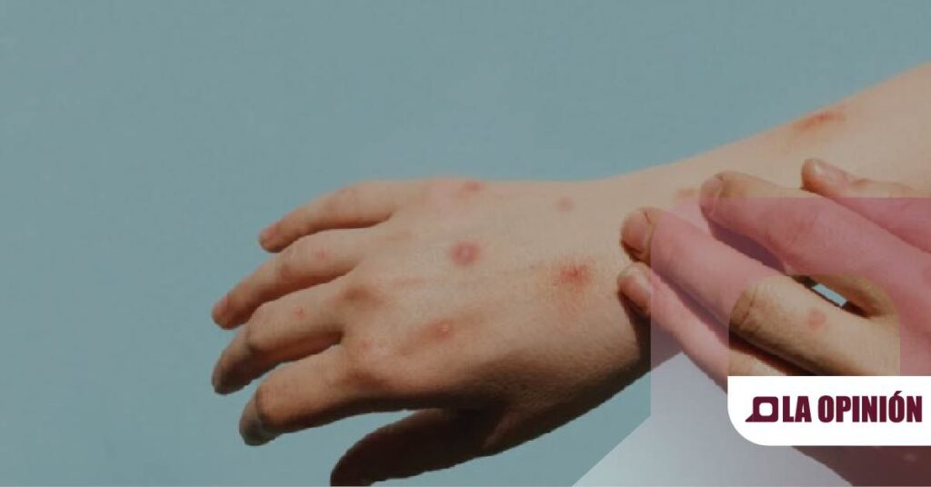 OMS en alerta por nueva cepa de viruela del mono: Aumento de casos en África