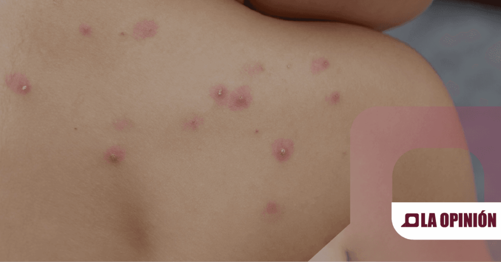 SSH descarta casos de la variante de Mpox en Hidalgo