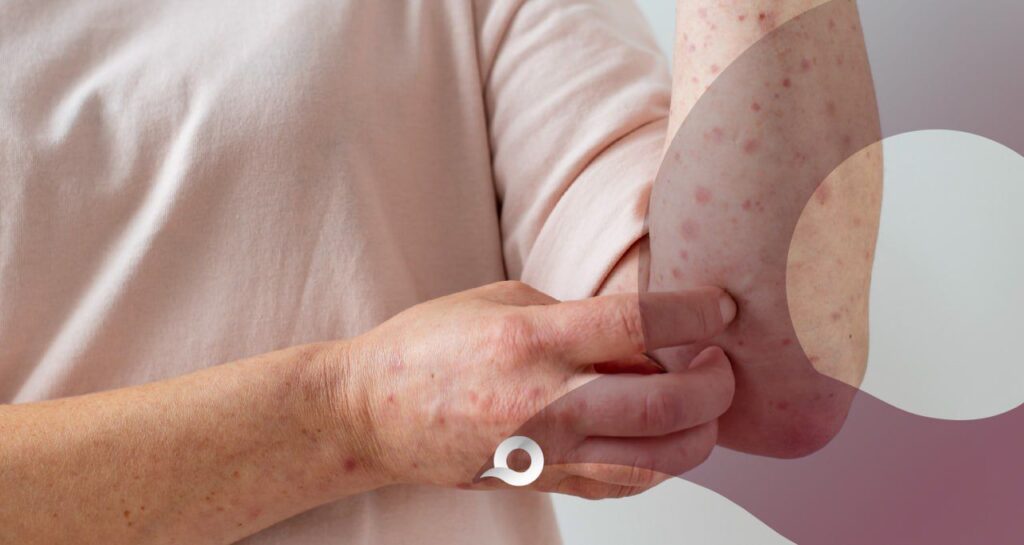 Varicela en Hidalgo: registran 192 casos activos