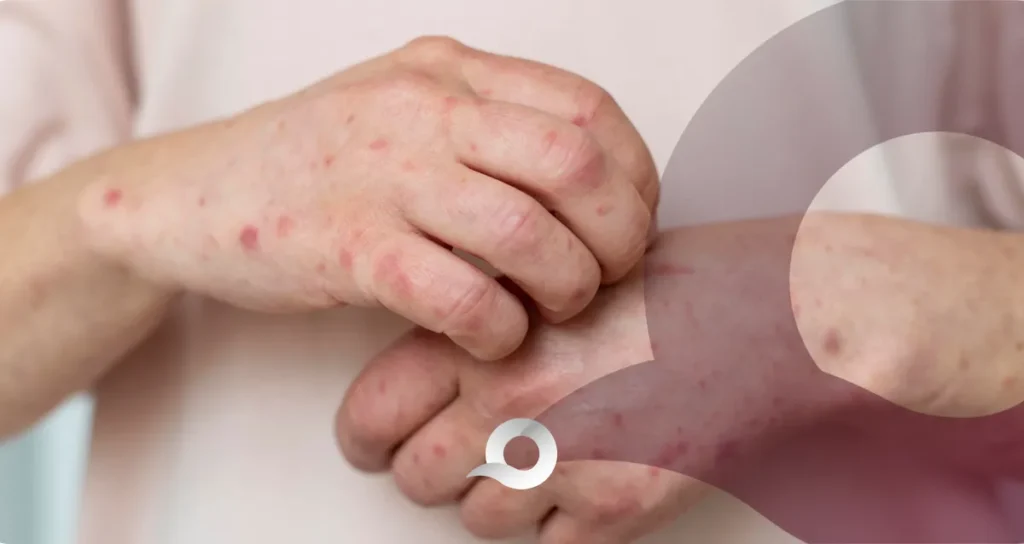 Hidalgo refuerza vigilancia epidemiológica ante aumento de casos probables de sarampión Hidalgo refuerza vigilancia epidemiológica ante aumento de casos probables de sarampión