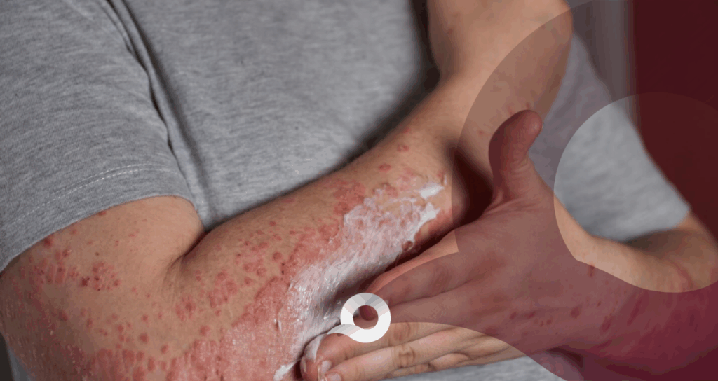 Sarampión en Hidalgo