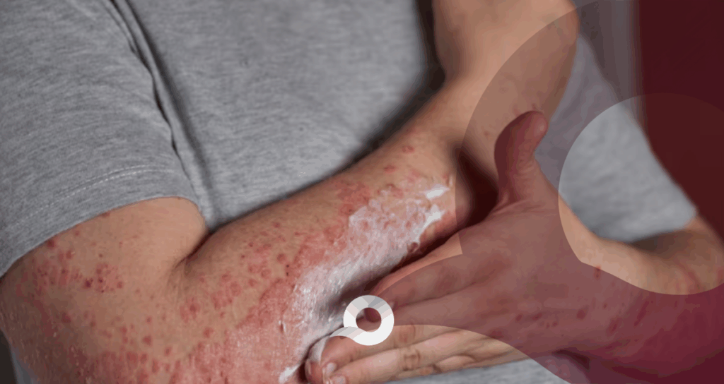 Sarampión México 2026